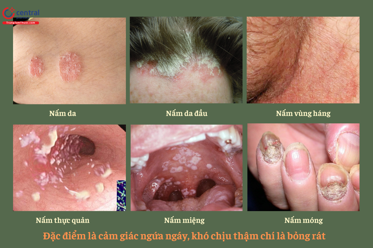 Nấm da, nấm móng, nấm âm đạo là các loại bệnh nhiễm nấm phổ biến