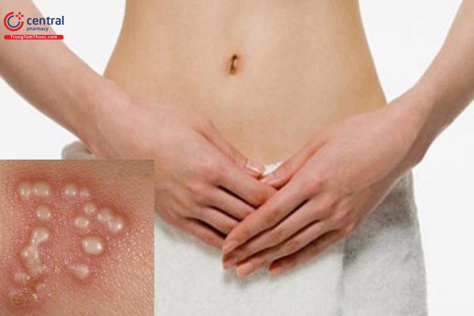 Hình ảnh Herpes sinh dục
