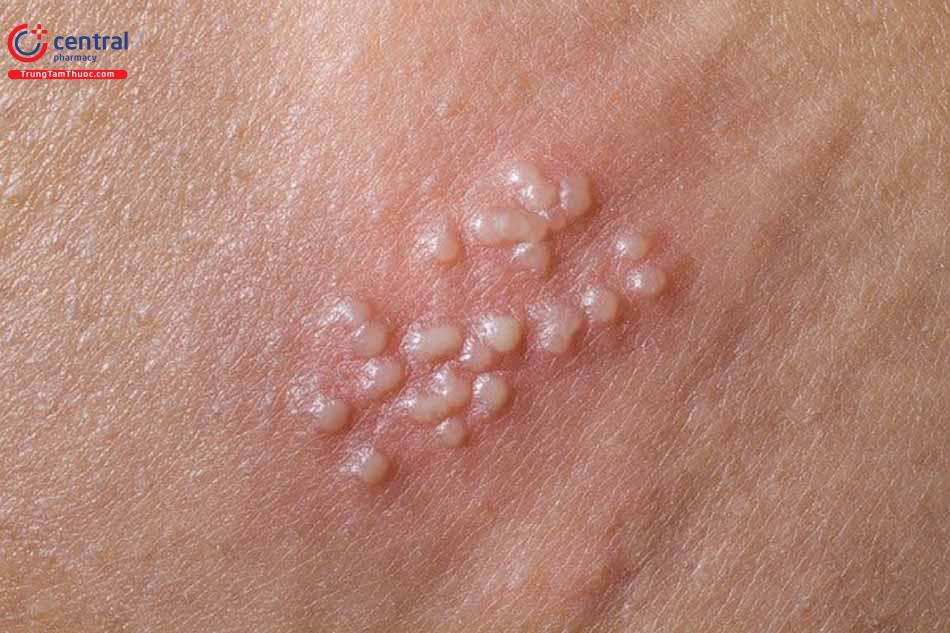 Mụn rộp sinh dục do HSV type 2