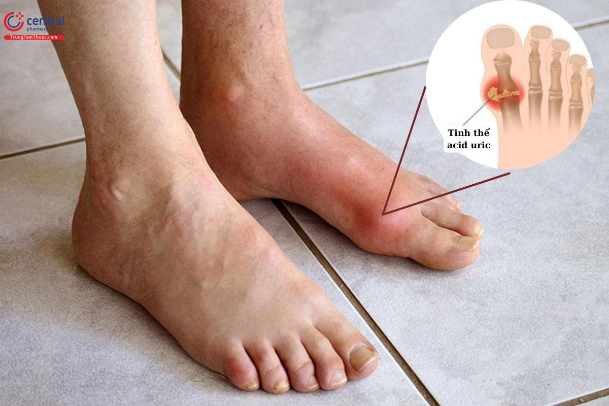 Hình ảnh bệnh Gút