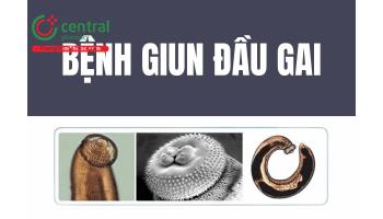 Bệnh giun đầu gai (Gnathostoma) có nguy hiểm không? Tác hại và phác đồ điều trị của Bộ Y tế