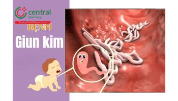 Bệnh giun kim (Enterobius vermicularis) lây qua đường nào? Cách điều trị ở người lớn và trẻ em