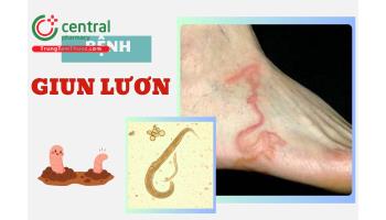 Bệnh giun lươn (Strongyloidiasis) có chữa được không? Triệu chứng và cách điều trị theo phác đồ Bộ Y tế
