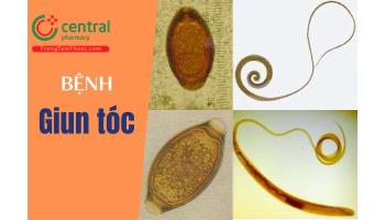 Giun tóc (Trichuris trichiura) gây bệnh gì? ký sinh ở đâu? Triệu chứng nhiễm và cách phòng tránh