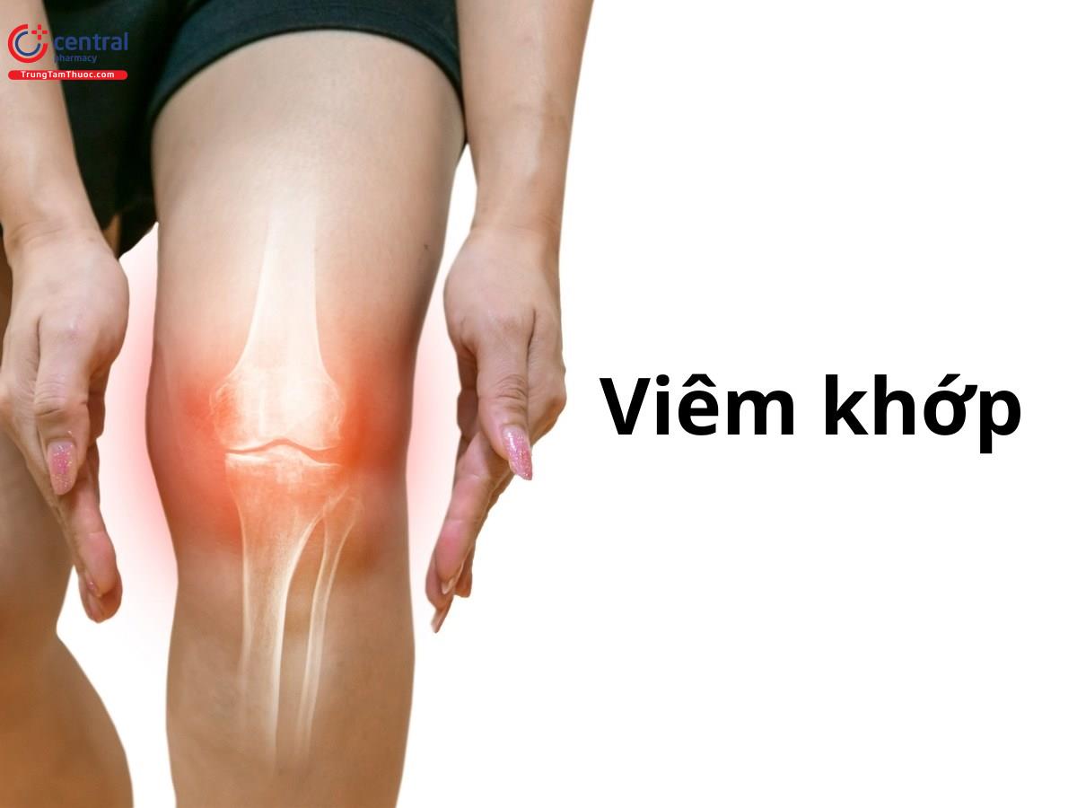Hình ảnh minh họa Viêm khớp
