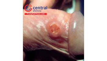 Bệnh u hạt bẹn: nguyên nhân, cách chẩn đoán và điều trị