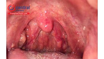 Bệnh viêm họng hạt và các biện pháp điều trị nhanh nhất tại nhà