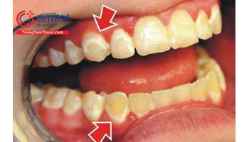 Bệnh viêm nha chu: nguyên nhân, chẩn đoán và điều trị 