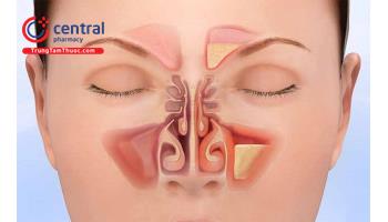 Bệnh viêm xoang cấp tính: Nguyên nhân, triệu chứng và điều trị 