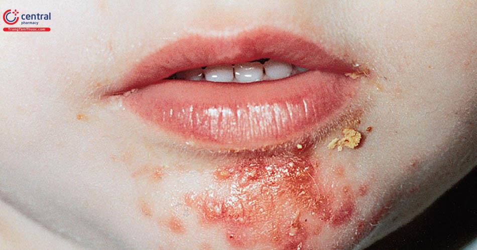 Triệu chứng của bệnh chốc