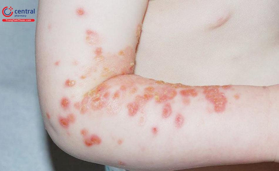 Hình ảnh người bị chốc