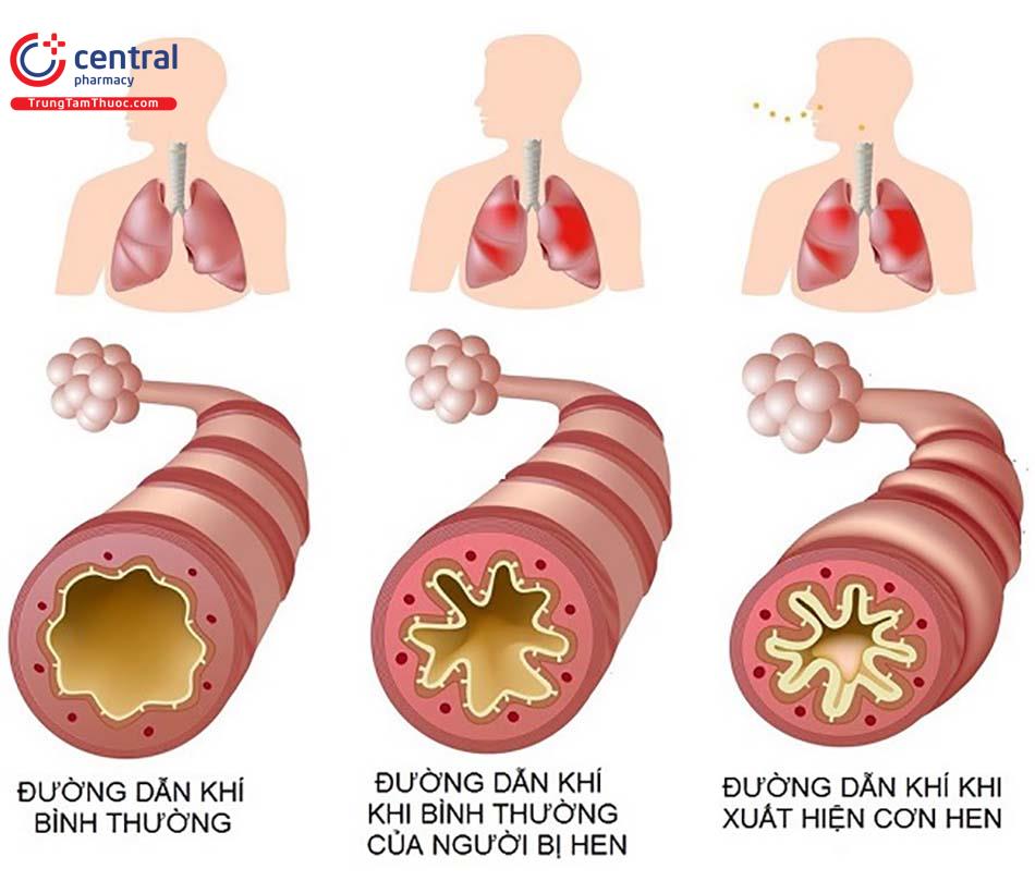 Bệnh hen phế quản