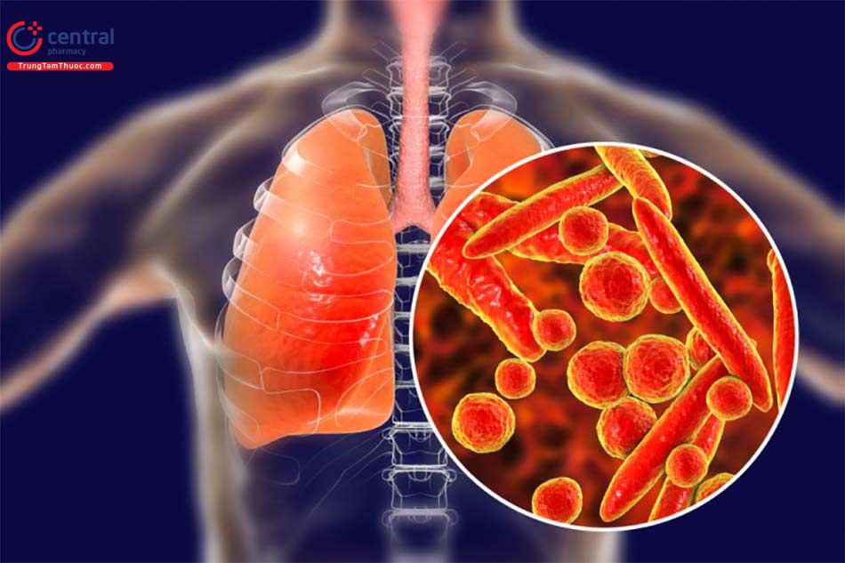 Bệnh lao do vi khuẩn Mycobacterium Tuberculosis gây ra