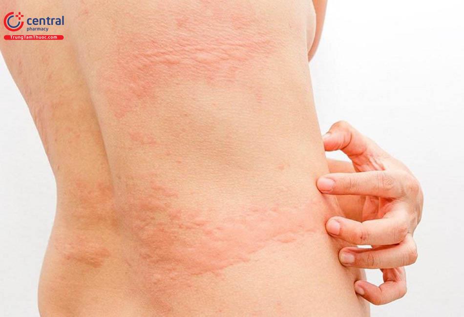 Hình ảnh bệnh mày đay
