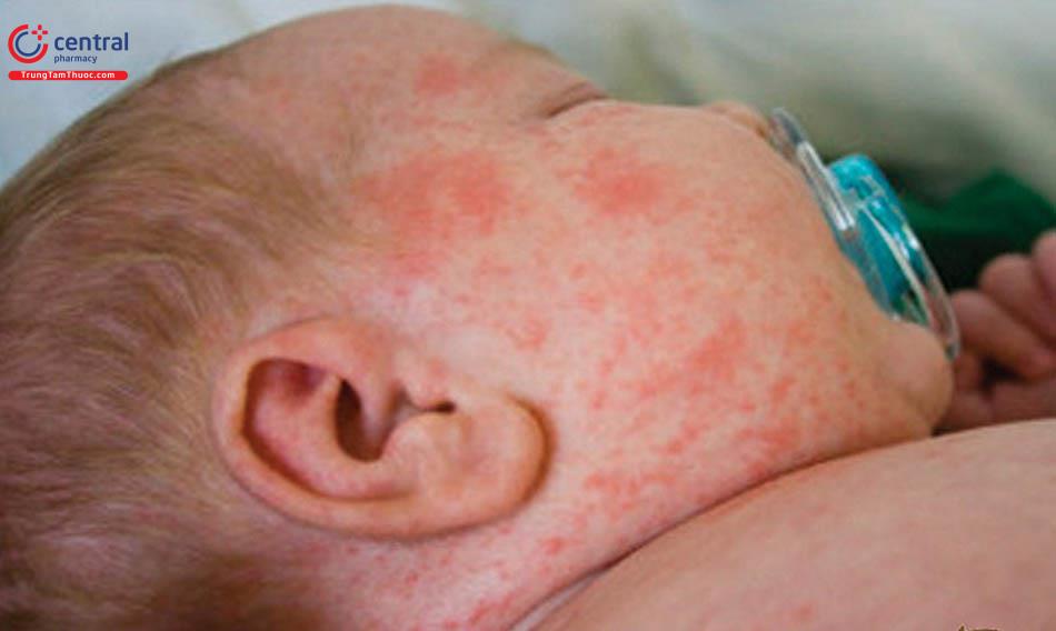 Hình ảnh người bị bệnh sởi