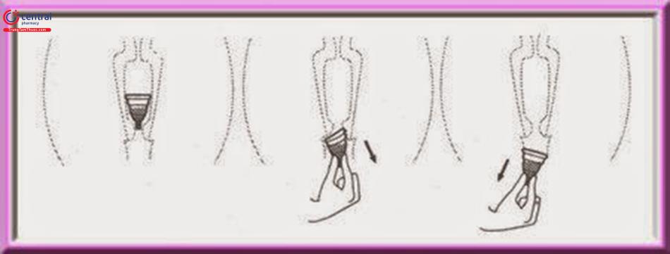 Thao tác lấy cốc nguyệt san đúng cách