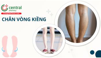 Chân vòng kiềng có chữa được không? Nguyên nhân và các bài tập khắc phục