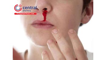 Chảy máu cam: Nguyên nhân, điều trị và phòng ngừa