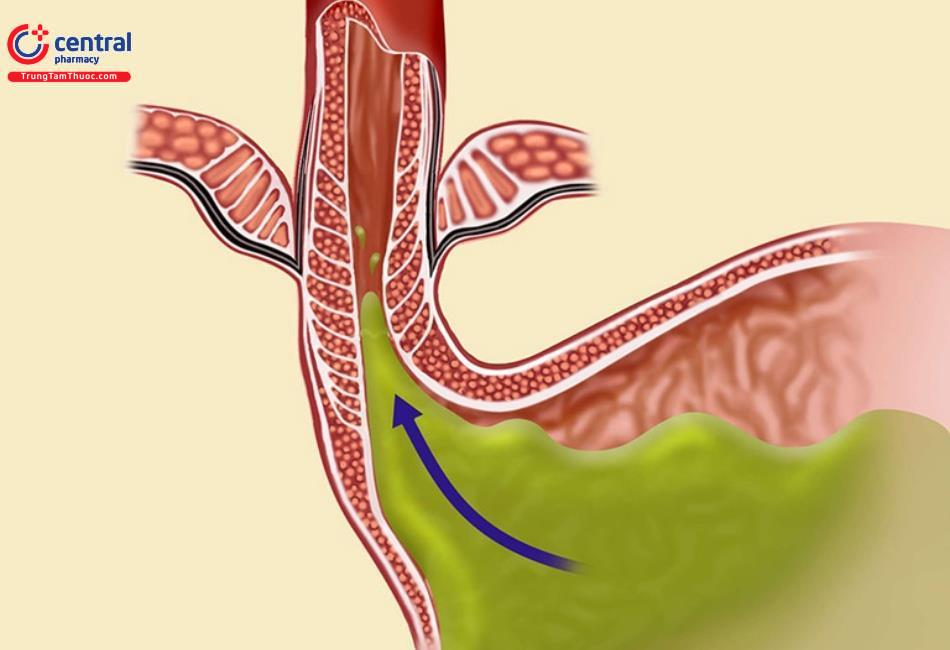 Thuốc chống nôn giúp ngăn chặn phản xạ gây nôn