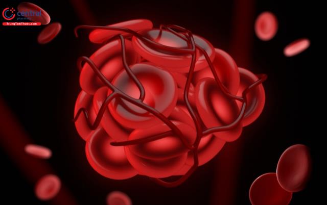 Rủi ro hình thành cục máu đông khi sử dụng thuốc tránh thai hàng ngày