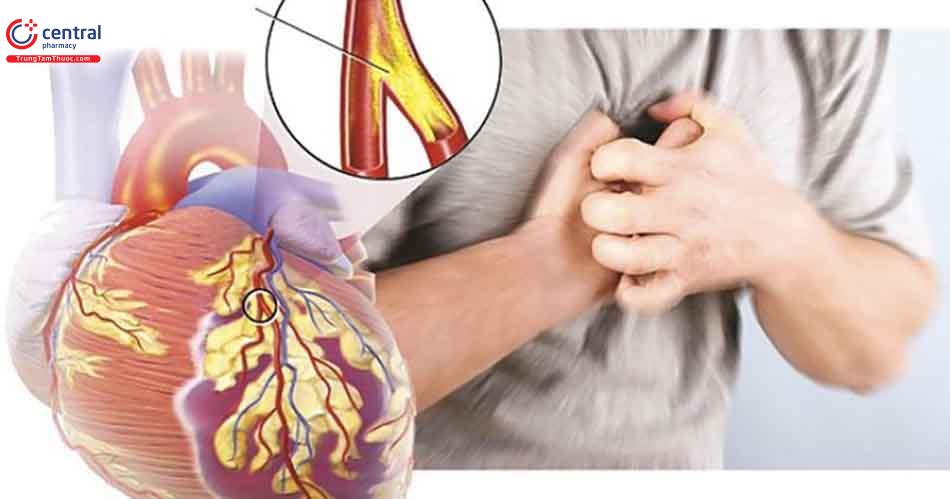 Bệnh đau thắt ngực