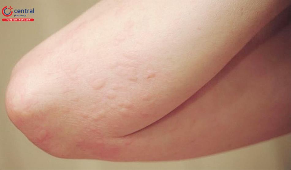 ​Có rất nhiều tác nhân gây ra các phản ứng dị ứng cho cơ thể