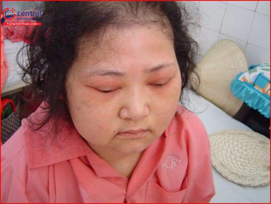 Sử dụng glucocorticoid trong thời gian dài có thể gây hội chứng Cushing 