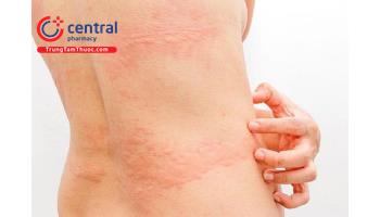 Dị ứng thức ăn: triệu chứng và cách chữa trị ai cũng nên biết