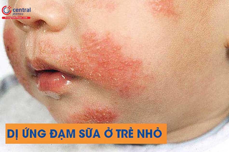 Dị ứng đạm ở trẻ nhỏ