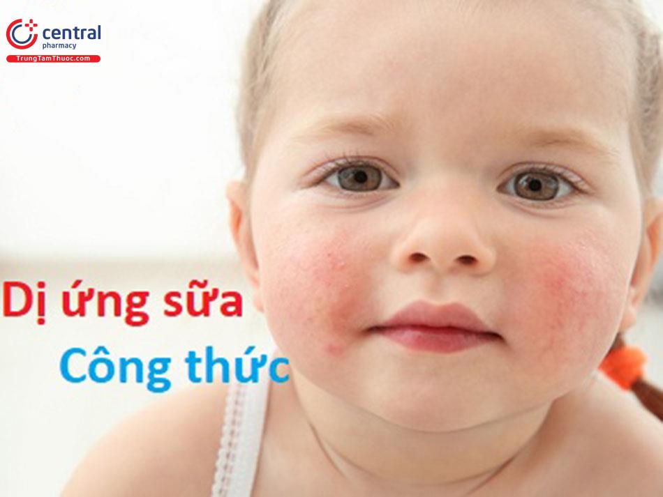 Dị ứng sữa thường gặp nhiều ở trẻ nhỏ