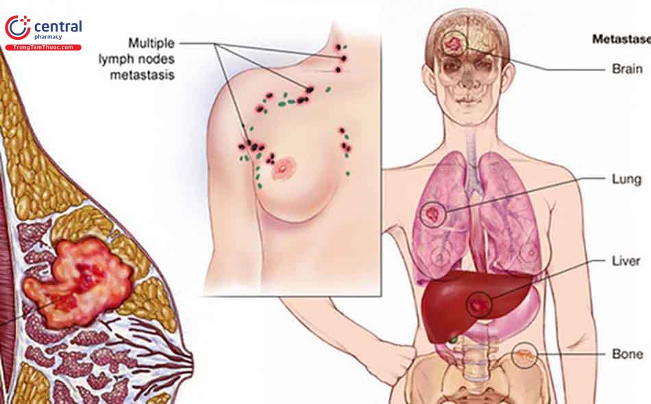 Điều trị nội tiết đem lại hiệu quả tốt đối với bệnh nhân ung thư vú