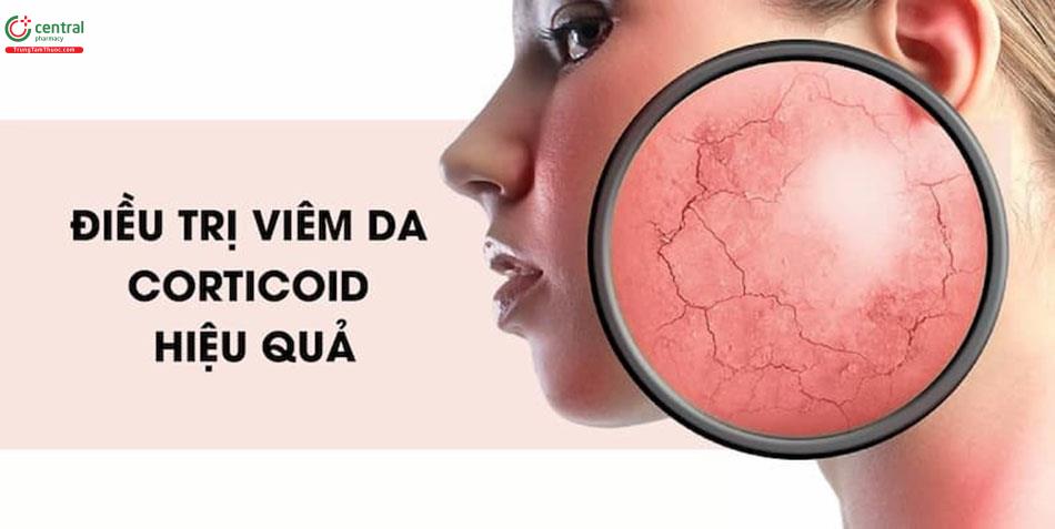 Điều trị viêm da bằng Corticoid