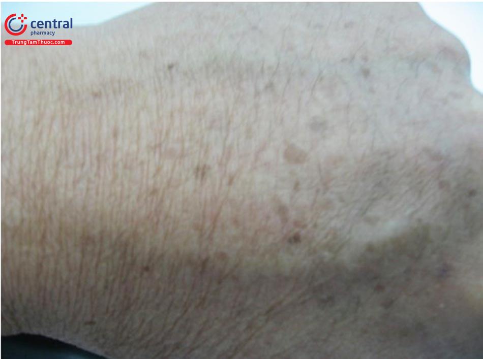 Hình ảnh hạt cơm phẳng ở mu bàn tay