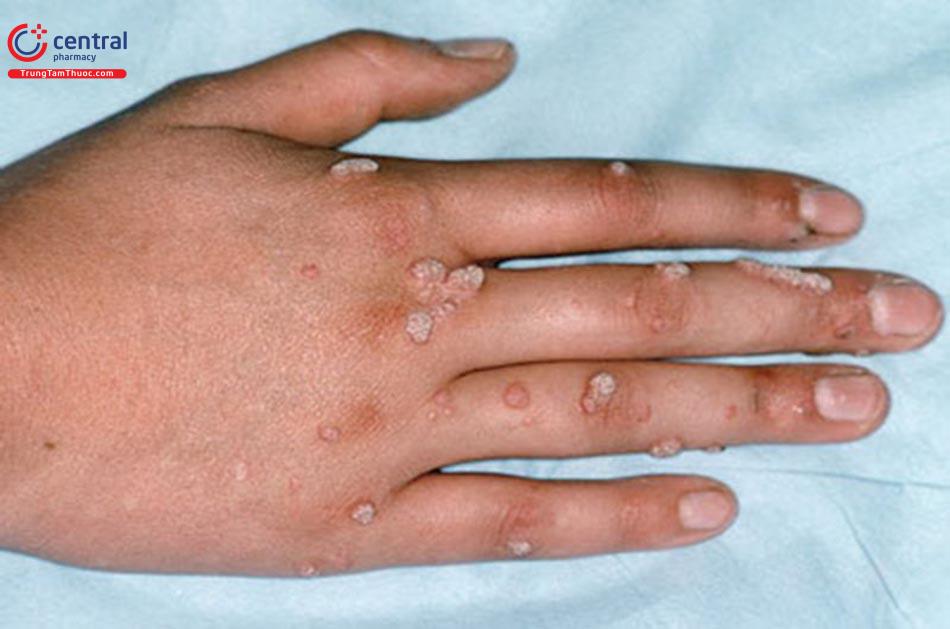 Hình ảnh bệnh hạt cơm thông thường