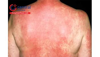 Hội chứng Dress: nguyên nhân, triệu chứng và cách điều trị