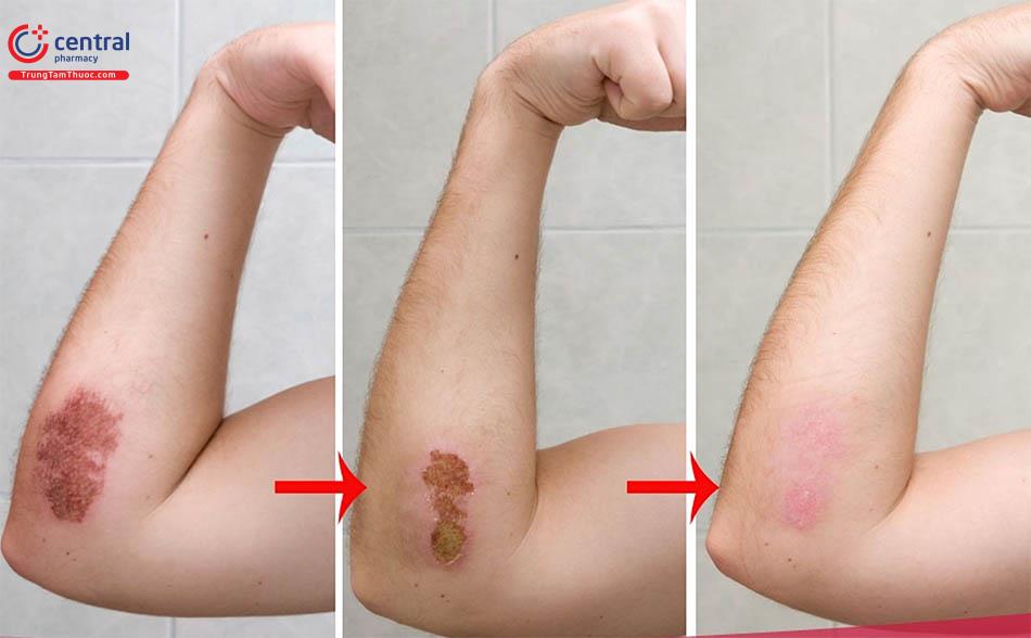 Lành vết thương