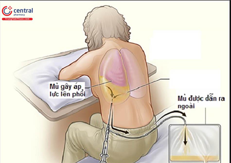 Bệnh lao màng phổi