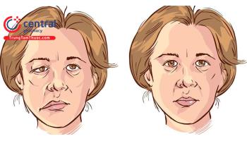 Liệt dây thần kinh VII ngoại biên: nguyên nhân, triệu chứng và điều trị