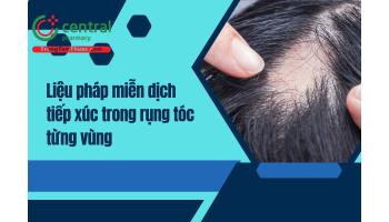 Ứng dụng liệu pháp miễn dịch tiếp xúc trong điều trị rụng tóc từng vùng