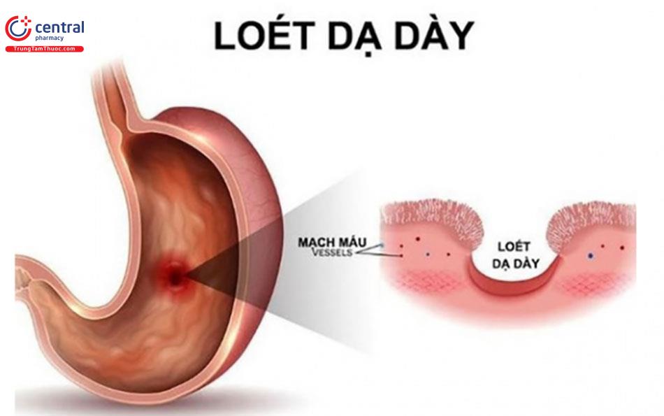 Loét dạ dày - tá tràng do dùng NSAIDs