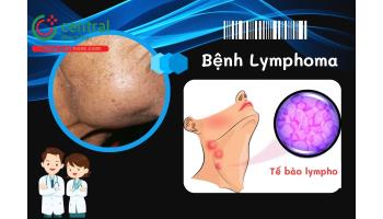 Bệnh ung thư hạch (Lymphoma): Phân loại, nguyên nhân, triệu chứng, chẩn đoán và điều trị