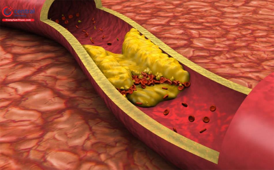 Hình ảnh mỡ trong mạch máu