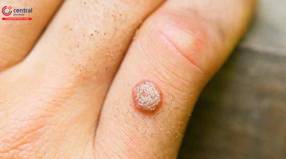 Mụn cóc ở tay do HPV