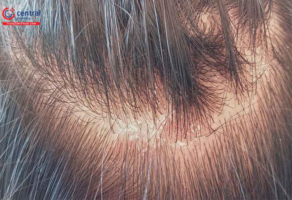 Hình ảnh nấm da đầu