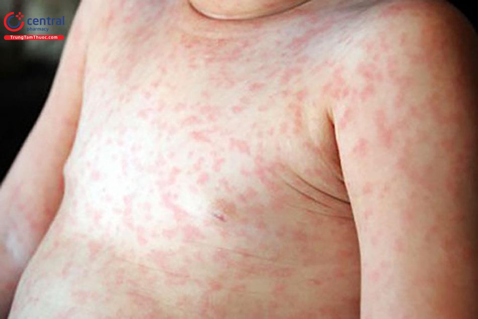 Nổi mẩn đỏ do dùng thuốc chống viêm giảm phù nề