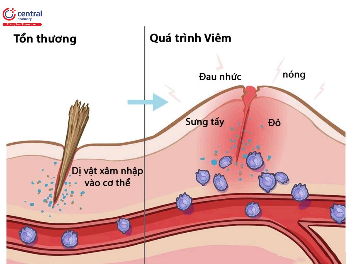 Quá trình xảy ra Viêm