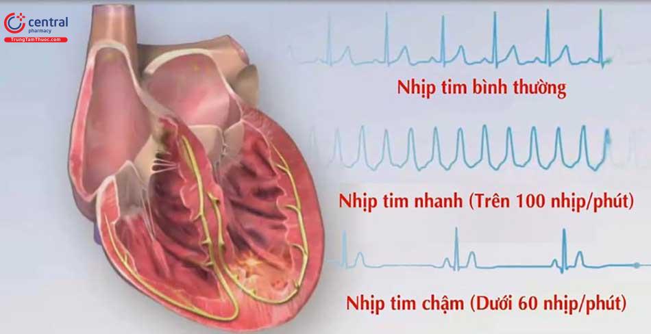 Rối loạn nhịp tim