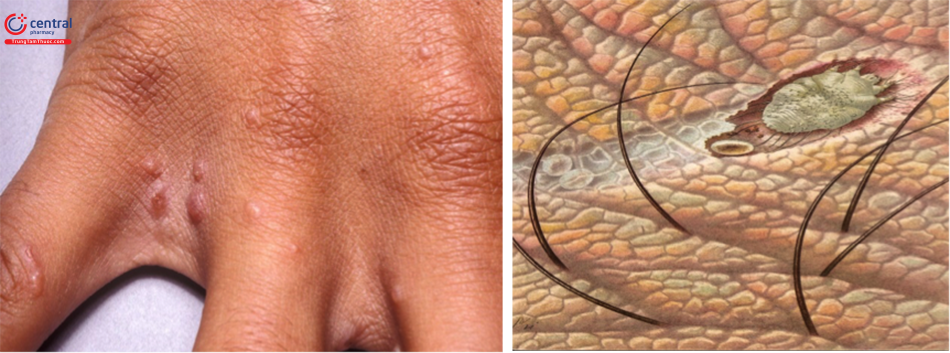 Hình ảnh săng ghẻ