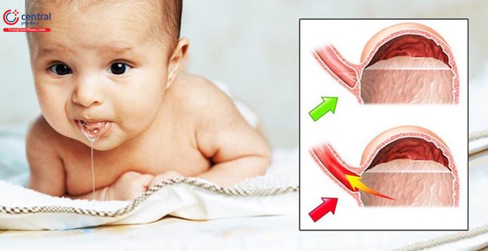 Hình ảnh sữa dành cho trẻ trào ngược dạ dày thực quản