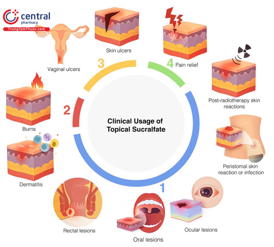 Hình 6: Các vị trí niêm mạc da mà Sucralfate có hiệu quả